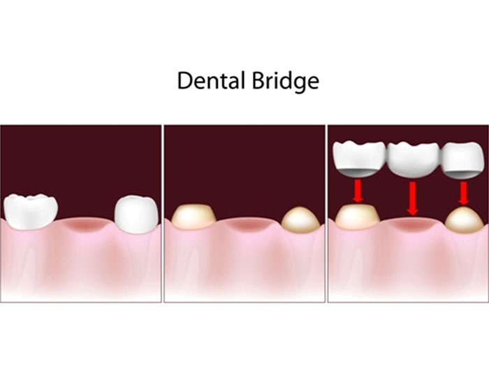 dental bridges in sw calgary