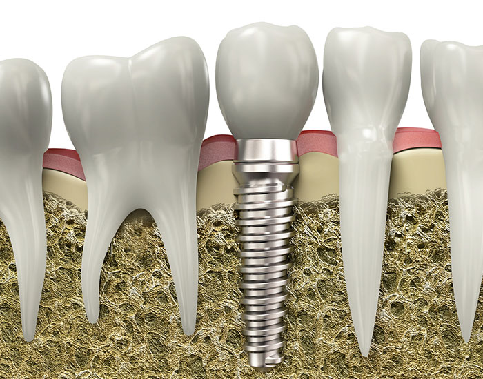 dental implants in sw calgary