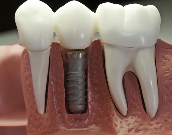 dental implants near you