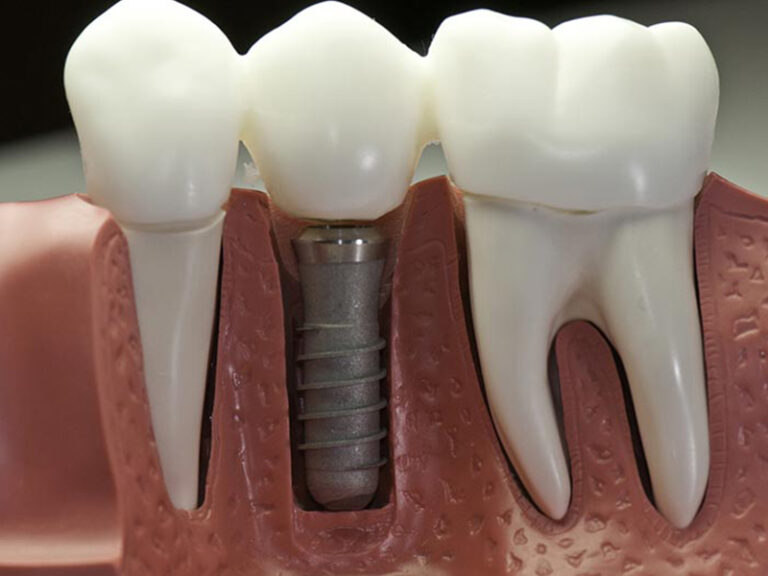 dental implants