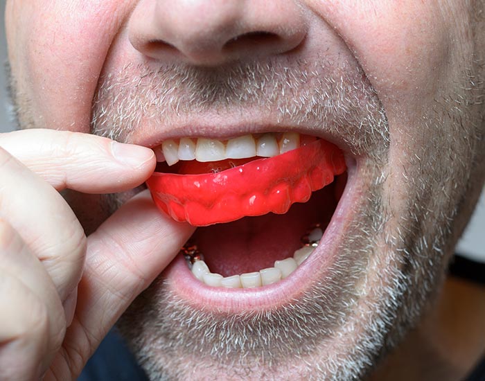 mouth guards near you in sw calgary