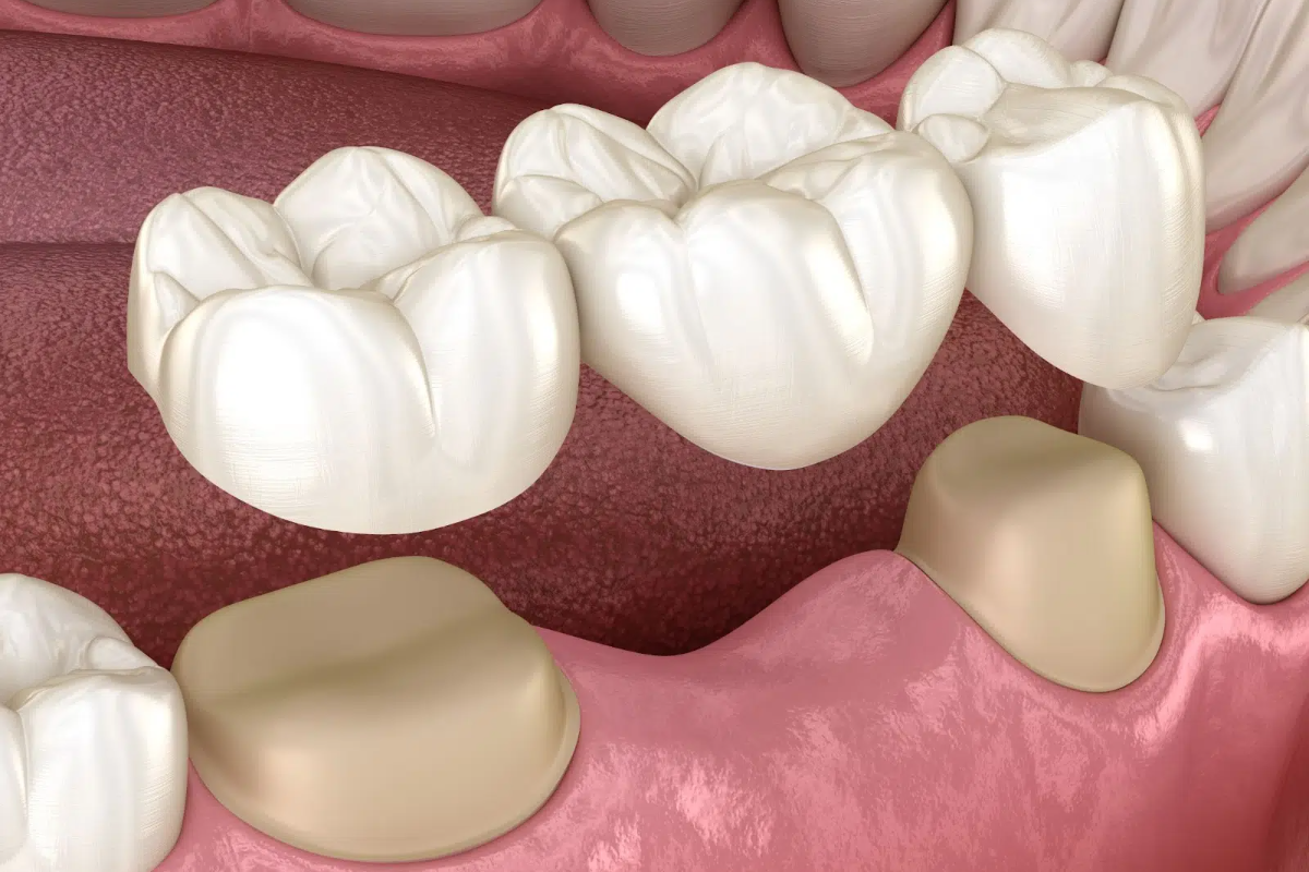 things you should know about dental bridges